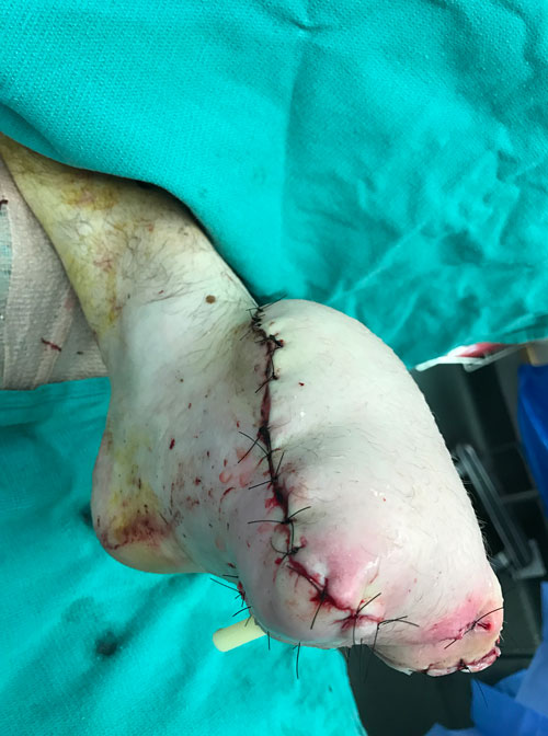 Patient's foot with stitches after surgery